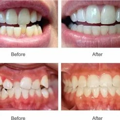Goedkoop π₯° SAMA Direct™ Rechte Tanden Zonder Beugel - Orthodontische Bitjes - Rechte Tanden Bitje - Beugel - Knarsbitje - Nachtbeugel - Knarsen Bitje - Rechte Tanden - Witte Tanden β¨ 7 Goedkoop π₯° SAMA Direct™ Rechte Tanden Zonder Beugel - Orthodontische Bitjes - Rechte Tanden Bitje - Beugel - Knarsbitje - Nachtbeugel - Knarsen Bitje - Rechte Tanden - Witte Tanden β¨ -BRAUN Shop 550x430 1