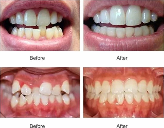 Goedkoop π₯° SAMA Direct™ Rechte Tanden Zonder Beugel - Orthodontische Bitjes - Rechte Tanden Bitje - Beugel - Knarsbitje - Nachtbeugel - Knarsen Bitje - Rechte Tanden - Witte Tanden β¨ 3 Goedkoop π₯° SAMA Direct™ Rechte Tanden Zonder Beugel - Orthodontische Bitjes - Rechte Tanden Bitje - Beugel - Knarsbitje - Nachtbeugel - Knarsen Bitje - Rechte Tanden - Witte Tanden β¨ - Afbeelding 3